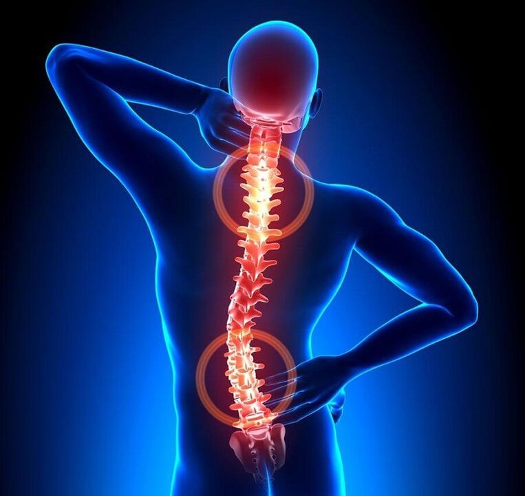Osteochondrose der Wirbelsäule als Ursache von Rückenschmerzen