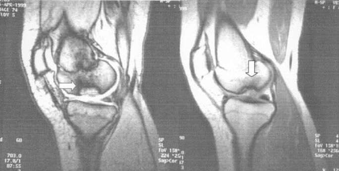Röntgenbild einer dissezierenden Osteochondrose im Kniegelenk