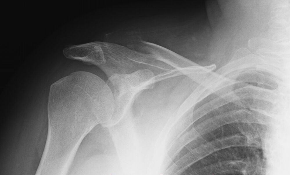 röntgen bei arthrose der schulter