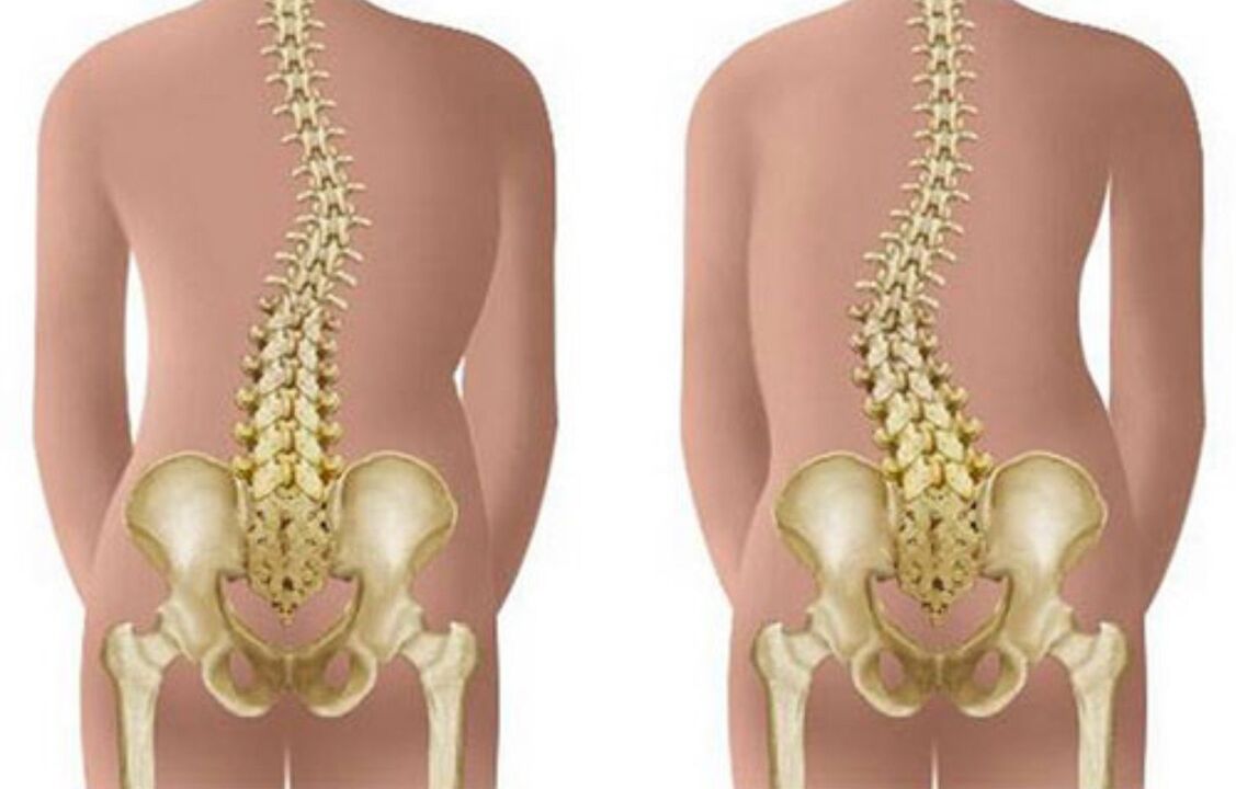 Skoliose als Ursache für Rückenschmerzen im Schulterblattbereich
