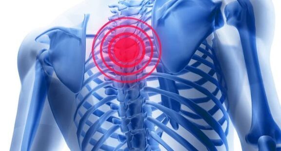 Behandlung der Osteocondrose der Brustwirbelsäule