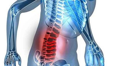 Anzeichen und Symptome einer lumbalen Osteochondose