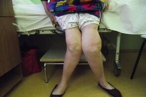 Fortgeschrittene Arthrose des Kniegelenks