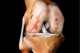 Schädigung des Kniegelenks durch Arthrose